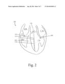 CATHETER ASSEMBLY FOR TREATMENT OF HYPERTROPHIC TISSUE diagram and image