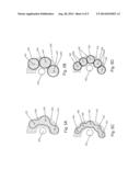 Methods of Treating the Sacroiliac Region of a Patient s Body diagram and image