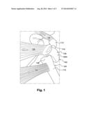 SURGICAL TECHNIQUE AND APPARATUS FOR PROXIMAL HUMERAL FRACTURE REPAIR diagram and image