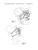 Periprosthetic Plating System with Compressive Plate and Transverse Bridge     Plate diagram and image