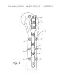 Periprosthetic Plating System with Compressive Plate and Transverse Bridge     Plate diagram and image