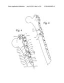 Periprosthetic Plating System with Compressive Plate and Transverse Bridge     Plate diagram and image