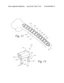 Periprosthetic Plating System with Compressive Plate and Transverse Bridge     Plate diagram and image