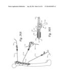 Periprosthetic Plating System with Compressive Plate and Transverse Bridge     Plate diagram and image