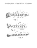 Periprosthetic Plating System with Compressive Plate and Transverse Bridge     Plate diagram and image