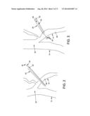 METHOD AND APPARATUS FOR OCCLUDING A BLOOD VESSEL AND/OR FOR OCCLUDING     OTHER TUBULAR STRUCTURES AND/OR FOR CLOSING OPENINGS IN STRUCTURES AND/OR     FOR SECURING AT LEAST TWO OBJECTS TOGETHER diagram and image