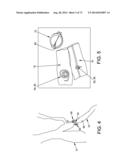 METHOD AND APPARATUS FOR OCCLUDING A BLOOD VESSEL AND/OR FOR OCCLUDING     OTHER TUBULAR STRUCTURES AND/OR FOR CLOSING OPENINGS IN STRUCTURES AND/OR     FOR SECURING AT LEAST TWO OBJECTS TOGETHER diagram and image