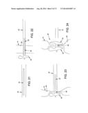 METHOD AND APPARATUS FOR OCCLUDING A BLOOD VESSEL AND/OR FOR OCCLUDING     OTHER TUBULAR STRUCTURES AND/OR FOR CLOSING OPENINGS IN STRUCTURES AND/OR     FOR SECURING AT LEAST TWO OBJECTS TOGETHER diagram and image