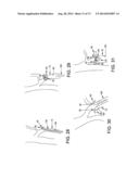 METHOD AND APPARATUS FOR OCCLUDING A BLOOD VESSEL AND/OR FOR OCCLUDING     OTHER TUBULAR STRUCTURES AND/OR FOR CLOSING OPENINGS IN STRUCTURES AND/OR     FOR SECURING AT LEAST TWO OBJECTS TOGETHER diagram and image