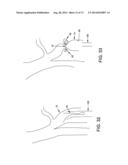 METHOD AND APPARATUS FOR OCCLUDING A BLOOD VESSEL AND/OR FOR OCCLUDING     OTHER TUBULAR STRUCTURES AND/OR FOR CLOSING OPENINGS IN STRUCTURES AND/OR     FOR SECURING AT LEAST TWO OBJECTS TOGETHER diagram and image