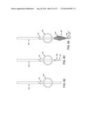 METHOD AND APPARATUS FOR OCCLUDING A BLOOD VESSEL AND/OR FOR OCCLUDING     OTHER TUBULAR STRUCTURES AND/OR FOR CLOSING OPENINGS IN STRUCTURES AND/OR     FOR SECURING AT LEAST TWO OBJECTS TOGETHER diagram and image