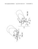 METHOD AND APPARATUS FOR OCCLUDING A BLOOD VESSEL AND/OR FOR OCCLUDING     OTHER TUBULAR STRUCTURES AND/OR FOR CLOSING OPENINGS IN STRUCTURES AND/OR     FOR SECURING AT LEAST TWO OBJECTS TOGETHER diagram and image