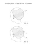 SYSTEM AND METHOD FOR ALIGNING HAIR FOLLICLE diagram and image