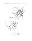 Periprosthetic Fracture Repair System Including Discrete Stabilized Crimp     Lugs for Cerclage Cable and Tool Therefor diagram and image