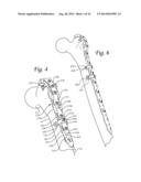 Periprosthetic Fracture Repair System Including Discrete Stabilized Crimp     Lugs for Cerclage Cable and Tool Therefor diagram and image