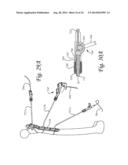 Periprosthetic Fracture Repair System Including Discrete Stabilized Crimp     Lugs for Cerclage Cable and Tool Therefor diagram and image