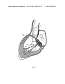 Methods and Apparatus for Endovascular Heart Valve Replacement Comprising     Tissue Grasping Elements diagram and image