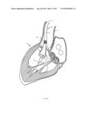 Methods and Apparatus for Endovascular Heart Valve Replacement Comprising     Tissue Grasping Elements diagram and image