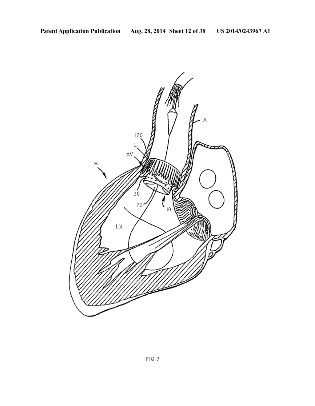 Methods and Apparatus for Endovascular Heart Valve Replacement Comprising     Tissue Grasping Elements - diagram, schematic, and image 13