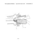 Methods and Apparatus for Endovascular Heart Valve Replacement Comprising     Tissue Grasping Elements diagram and image