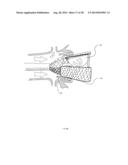 Methods and Apparatus for Endovascular Heart Valve Replacement Comprising     Tissue Grasping Elements diagram and image