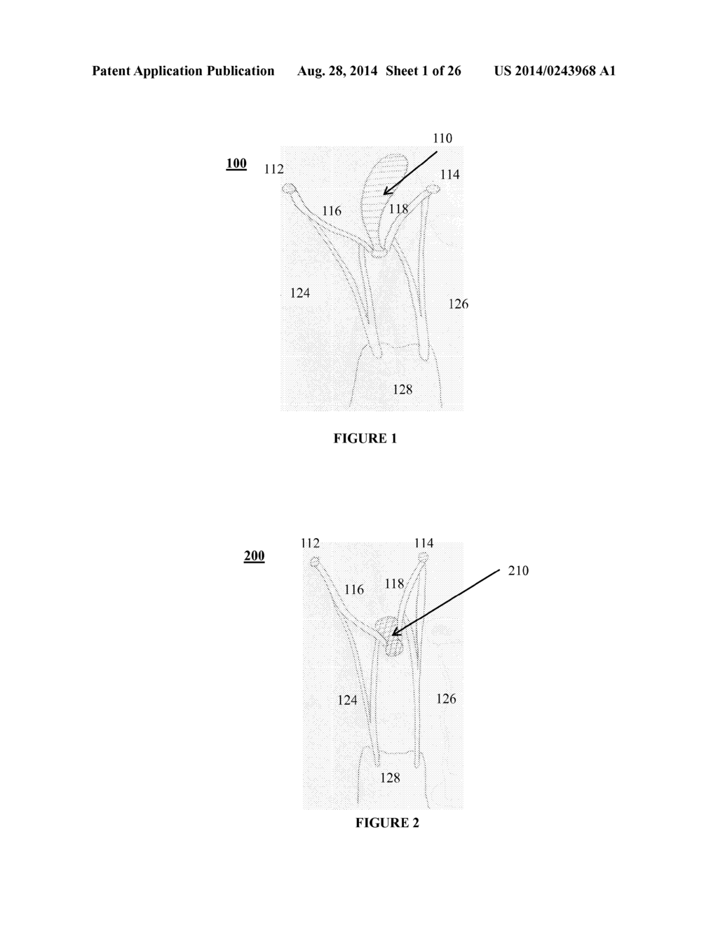 SYSTEMS, DEVICES AND METHODS FOR REPAIR OF HEART VALVE LESIONS - diagram, schematic, and image 02