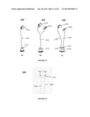 SYSTEMS, DEVICES AND METHODS FOR REPAIR OF HEART VALVE LESIONS diagram and image