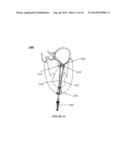 SYSTEMS, DEVICES AND METHODS FOR REPAIR OF HEART VALVE LESIONS diagram and image