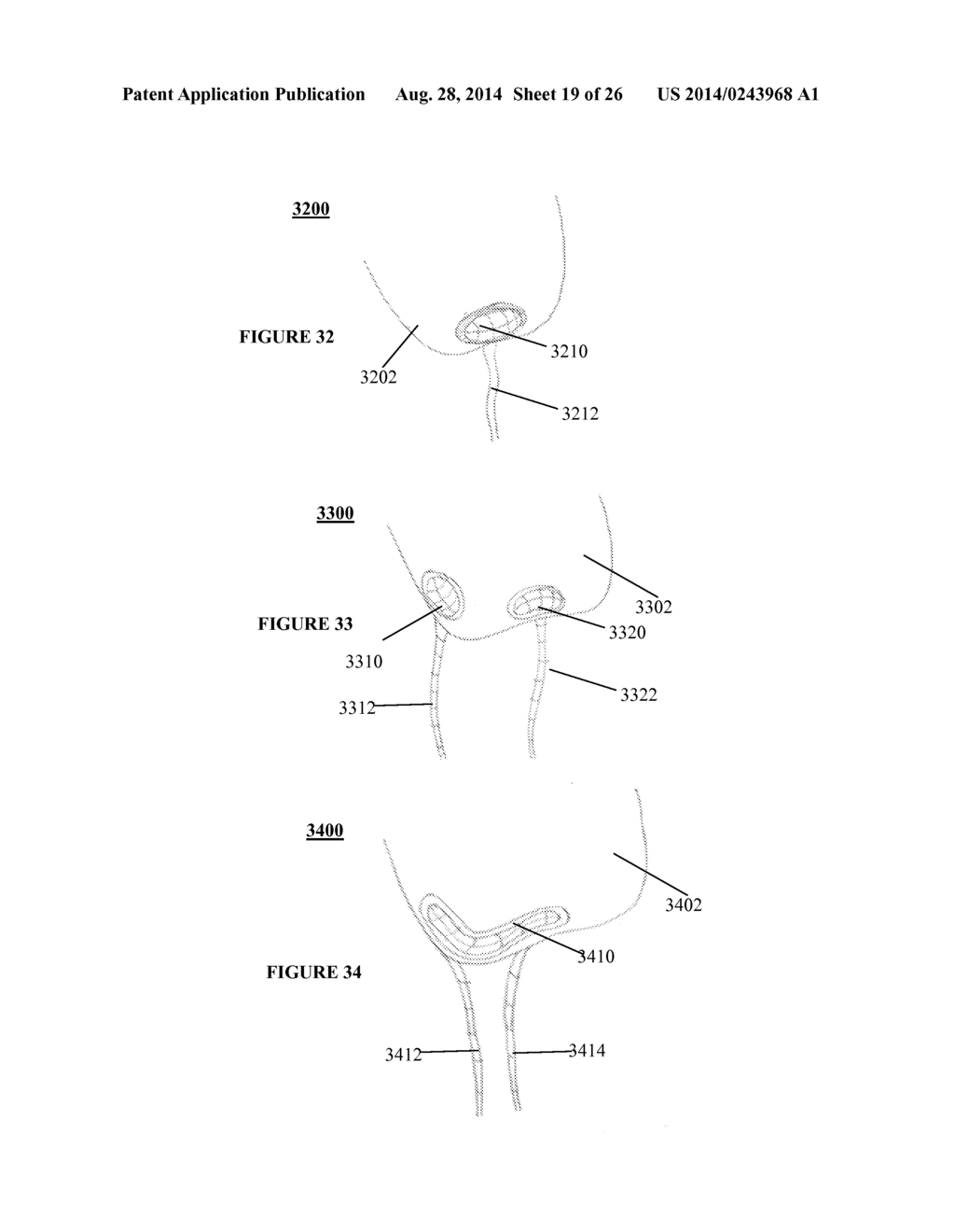 SYSTEMS, DEVICES AND METHODS FOR REPAIR OF HEART VALVE LESIONS - diagram, schematic, and image 20