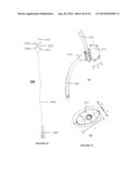 SYSTEMS, DEVICES AND METHODS FOR REPAIR OF HEART VALVE LESIONS diagram and image