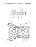 PROSTHETIC HEART VALVE WITH EXPANDABLE MICROSPHERES diagram and image