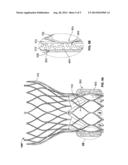 PROSTHETIC HEART VALVE WITH EXPANDABLE MICROSPHERES diagram and image