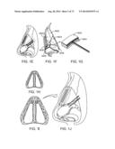 NASAL IMPLANTS AND SYSTEMS AND METHODS OF USE diagram and image