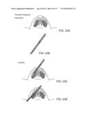 NASAL IMPLANTS AND SYSTEMS AND METHODS OF USE diagram and image