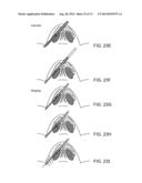 NASAL IMPLANTS AND SYSTEMS AND METHODS OF USE diagram and image