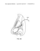 NASAL IMPLANTS AND SYSTEMS AND METHODS OF USE diagram and image