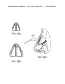 NASAL IMPLANTS AND SYSTEMS AND METHODS OF USE diagram and image