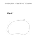 SYSTEMS AND METHODS FOR OPTIMIZING FIT OF AN IMPLANT TO ANATOMY diagram and image