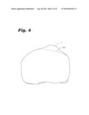 SYSTEMS AND METHODS FOR OPTIMIZING FIT OF AN IMPLANT TO ANATOMY diagram and image