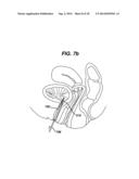 SYSTEM AND METHOD FOR NERVE STIMULATION diagram and image