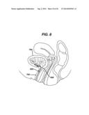 SYSTEM AND METHOD FOR NERVE STIMULATION diagram and image