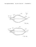 APPARATUS FOR TREATING VULNERABLE PLAQUE diagram and image