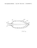 APPARATUS FOR TREATING VULNERABLE PLAQUE diagram and image