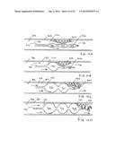 APPARATUS FOR TREATING VULNERABLE PLAQUE diagram and image