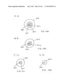 APPARATUS FOR TREATING VULNERABLE PLAQUE diagram and image