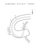 GUIDE EXTENSION CATHETER WITH A RETRACTABLE WIRE diagram and image