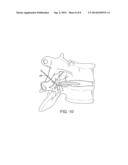 PAIN MANAGEMENT USING CRYOGENIC REMODELING diagram and image