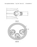 ATHERECTOMY DEVICES AND METHODS diagram and image