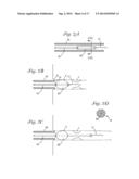 CATHETER WITH OCCLUDING CUFF diagram and image