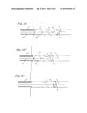 CATHETER WITH OCCLUDING CUFF diagram and image